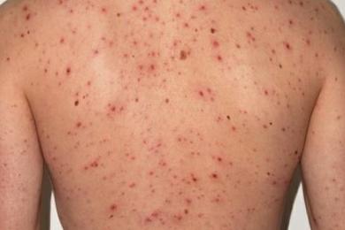 सर्लाहीको मलङ्गवामा दादुरा सङ्क्रमण फैलियो